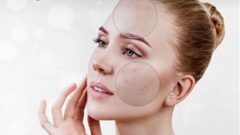 Behandlung von unreiner Haut bei Kosmetik Oppenheimer